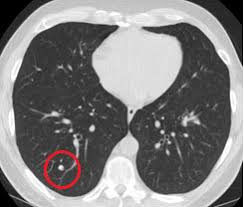 Another name for ldct is. Ct Scans Lower Lung Cancer Deaths According To Study