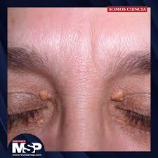 Image result for xantelasma