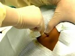 You may also have this test to check how well your treatment is working. Bone Marrow Aspiration And Biopsy Youtube