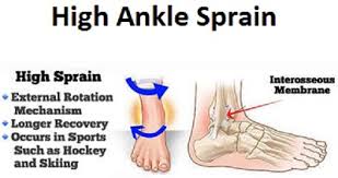 Whereas, in case of grade 3 type of muscle tear patients. Guide For Speed Up High Ankle Sprain Recovery Time