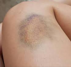 Toothpaste dissociates any blood clot on the skin's surface. Calayan Skin Clinic Lucena City What Will Make Bruises Go Away Fast There Are Several Things You Can Do To Get Rid Of A Bruise Faster At Home Bruises Are