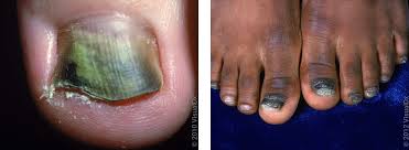 Image result for Pitting nails feet