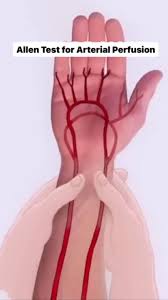 Image result for Allen Test