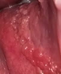 Vestibüler papillomatoz vajinanın dış parçası olan bir kadının vulva, küçük, parlak, deri renkli büyümeleri değinmektedir. Do Breast Papillomas Hurt Vestibular Papillomatosis Hurt Vestibular Papillomatosis Hurt