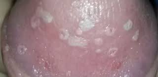 Vorbeugende Massnahmen Und Behandlungsmethoden Ursachen Und Behandlung Von Weissen Flecken Auf Dem Penis