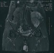 Image result for Chondrosarcoma