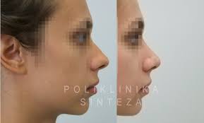 Implantate in rhinoplastik eingesetzt kann das risiko einer infektion. Nasenoperation Rhinoplastik Vom Experten Zagreb Kroatien
