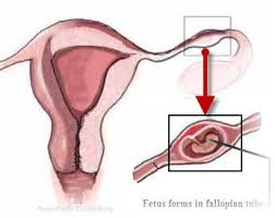 Ectopic Pregnancy Symptoms