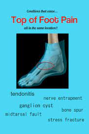 Pin On Foot Pain