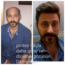 Protez Sacla Daha Genc Ve Dinamik Gorunun Sac Proteziyle Kisa Bir Sure Icerisinde Daha Genc Karizmatik Ve Daha Dinamik Daha Iyi Gor Sac Yaslanma Dogal Sac