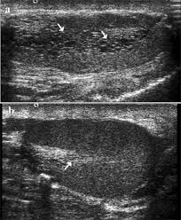 (1994) the journal of urology. Ectasia Of The Rete Testis Beware Of This Masquerader Abstract Europe Pmc