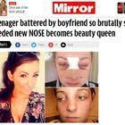 Si rifà il naso dopo i morsi del suo ex violento. Lacy, 19 anni, ora è una  reginetta di bellezza