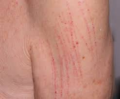Pruritus may be confined to the hands, feet or lower legs, or it can affect the entire body. Pin On Lymphoma