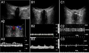 The typical presentation is sudden. Retrobulbar Spot Sign Predicts Thrombolytic Treatment Effects And Etiology In Central Retinal Artery Occlusion Stroke