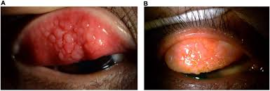 Image result for Vernal Conjunctivitis