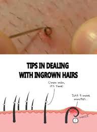 Temporary pubic hair removal methods are much more common, and can be carried out at home or in a professional salon, depending on your preferences. 9 Ingrown Hair Ideas Ingrown Hair Ingrown Hair Remedies Ingrown Hair Removal