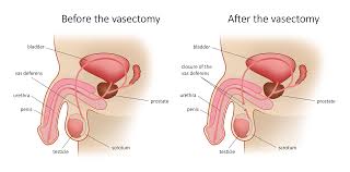 Image result for Vasectomy