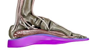 Sinus Tarsi Syndrome Treatment Solescience Custom Orthotics
