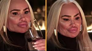 Darcey Silva's SHOCKING Face After Removing Fillers From Her Face!