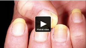 Image result for mykoza nehtů