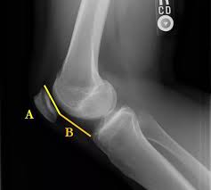 Image result for Patellar Dislocation