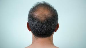 However, anyone can be affected by ingrown hair. Scalp Conditions Pictures Causes And Treatments