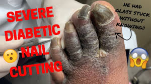 Image result for toe black diabetes