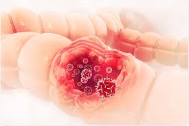 Cancer of the colon affects more than 100,000 americans each year. Does Oral Bacteria Affect Colon Cancer