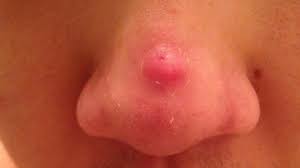 Emuaid.com has been visited by 100k+ users in the past month How To Get Rid Of Pimples On Nose Fast And Overnight