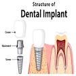 Implant clinic product image