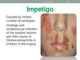 Pin By Great Wolf On Impetigo Impetigo Dermatology Streptococcal Infection