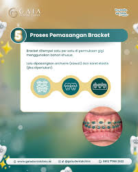 ✨ Baru 2x kontrol tapi giginya udah mulai nurut! Pergerakan gigi itu nggak  selalu lama, asal kasusnya tepat dan rutin kontrol, progres bisa kelihatan  secepat ini. Dari yang awalnya berjejal, sekarang mulai