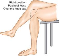 Image result for Crossed-Leg Test