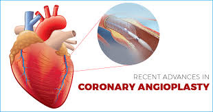 Angioplasty is a procedure in which a tiny device is inserted into narrowed blood vessels that supply blood to the heart. Recent Advances In Coronary Angioplasty Apollo Hospitals Blog