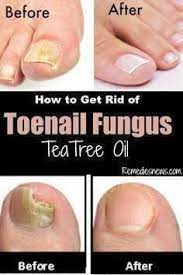 Pin By Susan Chadwick Cyrus On Ingrown Toenail Fungus Remedies Toenail Fungus Tea Tree Oil For Acne