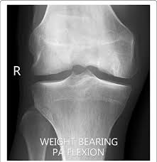 Check spelling or type a new query. X Ray Of The Knee Showing Flattening Of The Medial Femoral Condyle And Download Scientific Diagram
