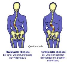 Ruckenschmerzen Ischias Hexenschuss Www Patientenleitlinien De Ruckenschmerz Lumbago