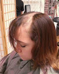 Partial hair pieces that only cover thinning hair or spots; An Alternative To Human Hair Wigs Intralace Freewear System From Lucinda Ellery Inc