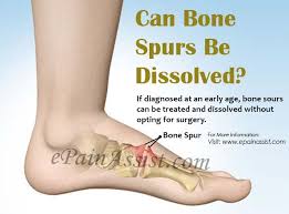 Bones block 2 shots and/or deals 2 ticks of damage before breaking. Can Bone Spurs Be Dissolved