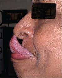 He got around that by licking his boogers out with his tongue. Gorlin Sign Wikipedia