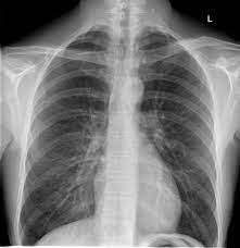 When this collection of gas is constantly enlarging with resulting. Pneumothorax Radiology Case Radiopaedia Org