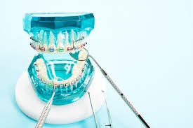 If you've ever had braces, or if you have braces right now, then there's a chance that your orthodontist has asked you to wear rubber bands. Helpful Tips For Using Rubber Bands With Braces Dental Signal