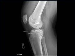 Image result for Patellar Dislocation