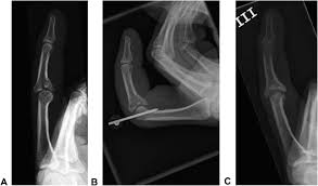 Image result for Lateral PIP Dislocation