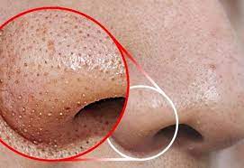 Dibandingkan komedo putih, blackhead lebih susah untuk dipunahkan dari wajahmu. Tak Perlu Picit Blackhead Whitehead Akan Hilang Dengan Mudah Guna 9 Cara Ini Maskulin