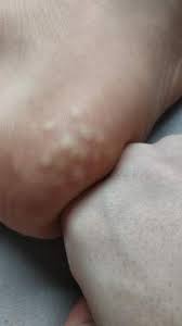 Weisse Punkte Im Hacken Fuss Gesundheit Medizin Fusse