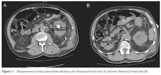 Hypertension associated with renal parenchymal disease occurs as a complication of a wide variety of glomerular and interstitial renal diseases and may accelerate the. Scielo Brasil Renal Parenchyma Thickness A Rapid Estimation Of Renal Function On Computed Tomography Renal Parenchyma Thickness A Rapid Estimation Of Renal Function On Computed Tomography