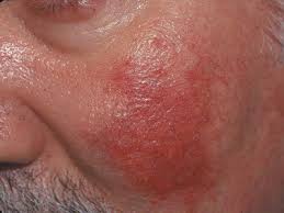 Image result for red rash face