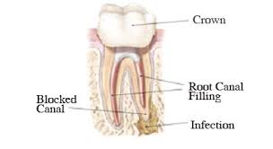 You won't feel anything as your dentist makes a small opening in the crown of your tooth to clean and remove the dead or diseased pulp tissue inside. Crown Vs Root Canal Adams Cheek Family Dentistry
