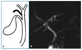 Maybe you would like to learn more about one of these? Normal Anatomy Of The Biliary Tree Gallbladder And Pancreatic Duct Springerlink
